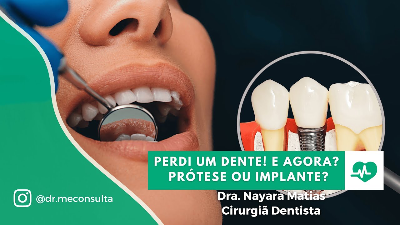 Perdi um dente! É melhor colocar uma Prótese ou um Implante?