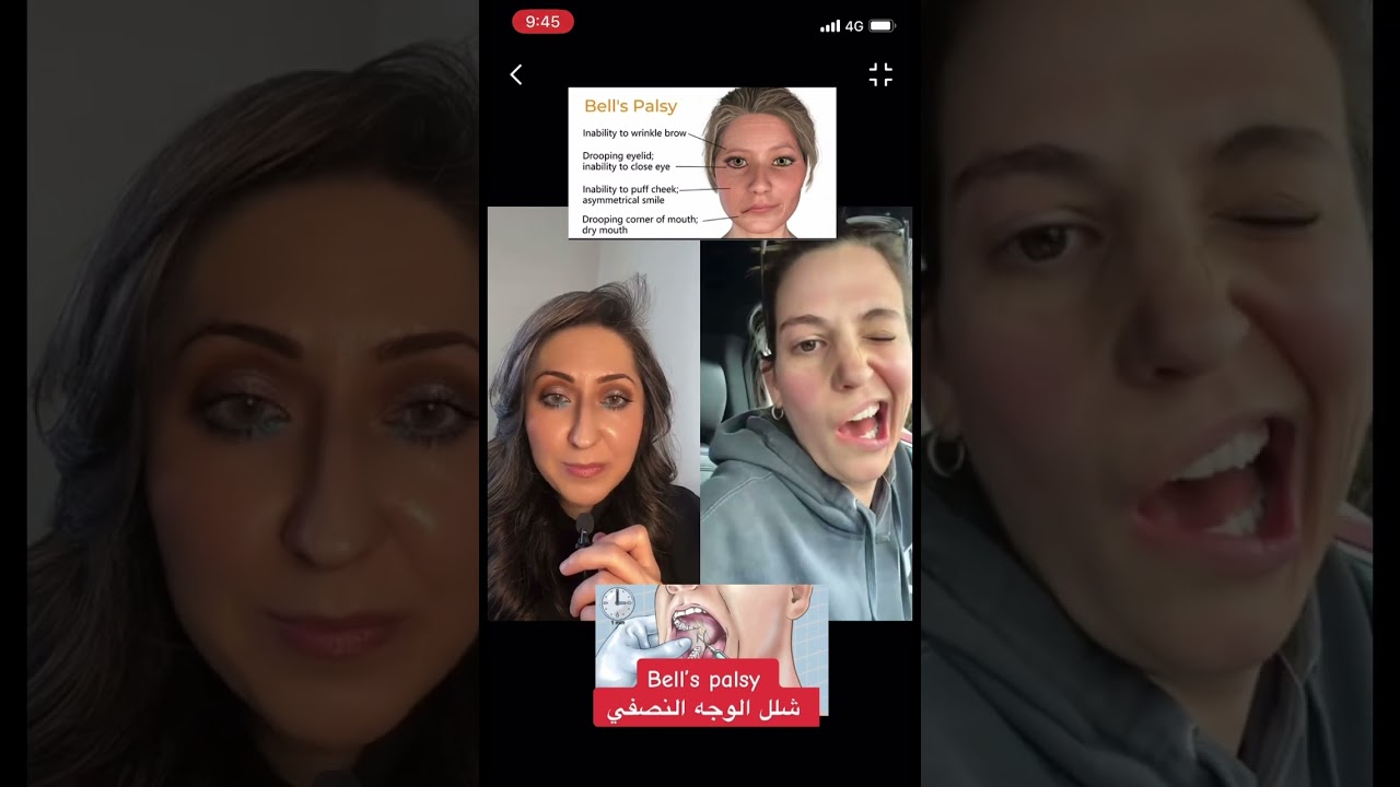 Bell&rsquo;s palsy #facialparalysis #شلل _الوجه_النصفي