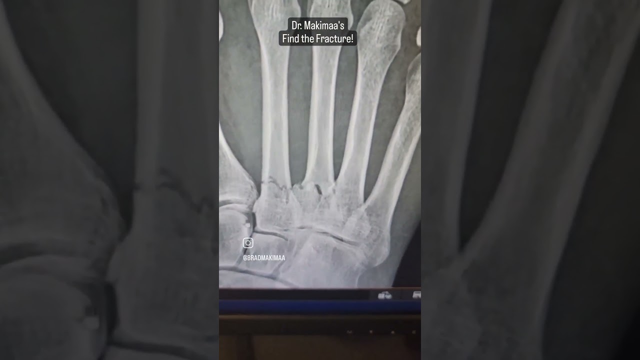 Find the fracture - multiple metatarsal fractures
