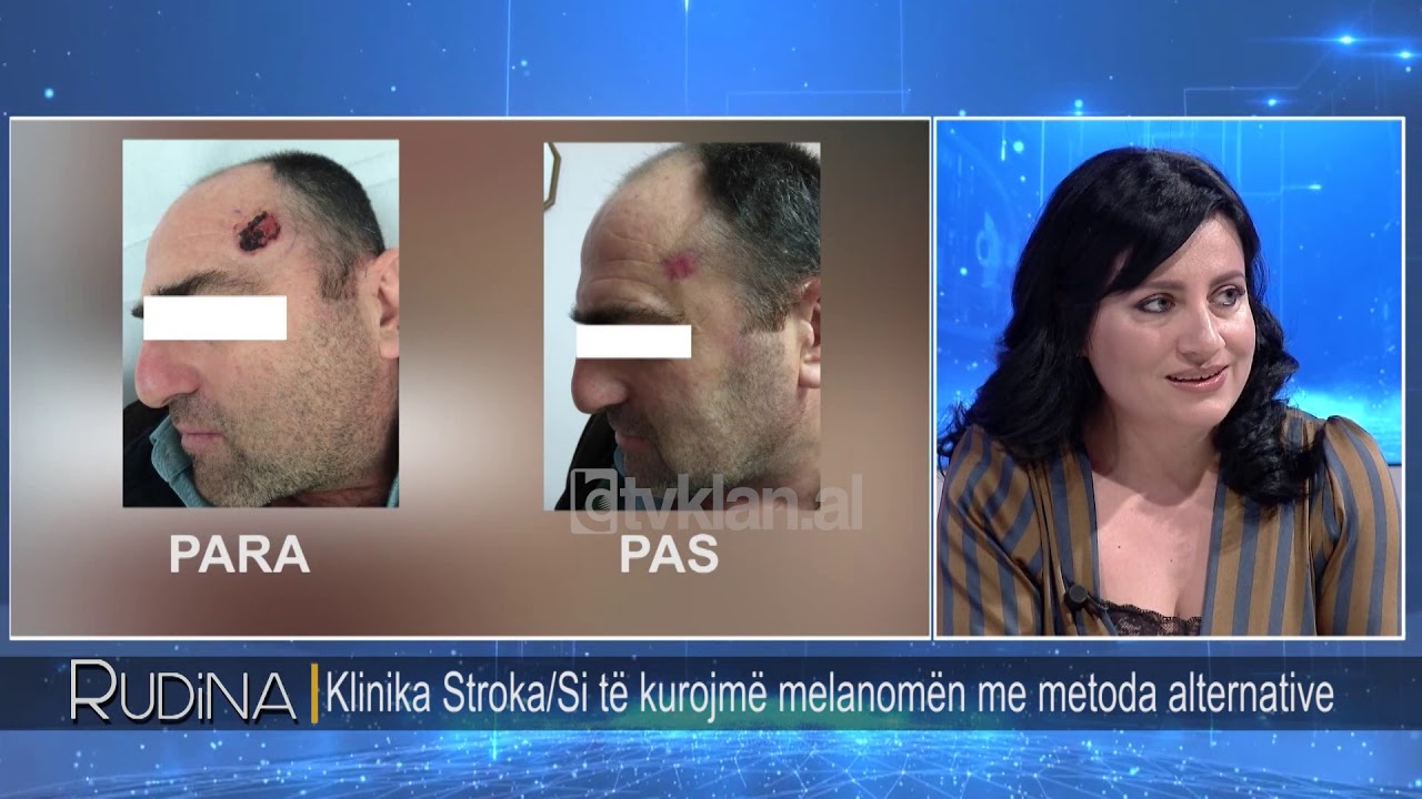 Rudina - Klinika Stroka/ Si te kurojme melanomen me metoda alternative! (25 tetor 2018)