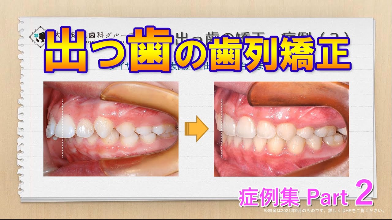 出っ歯の歯列矯正症例集② ～ クローバー歯科クリニック
