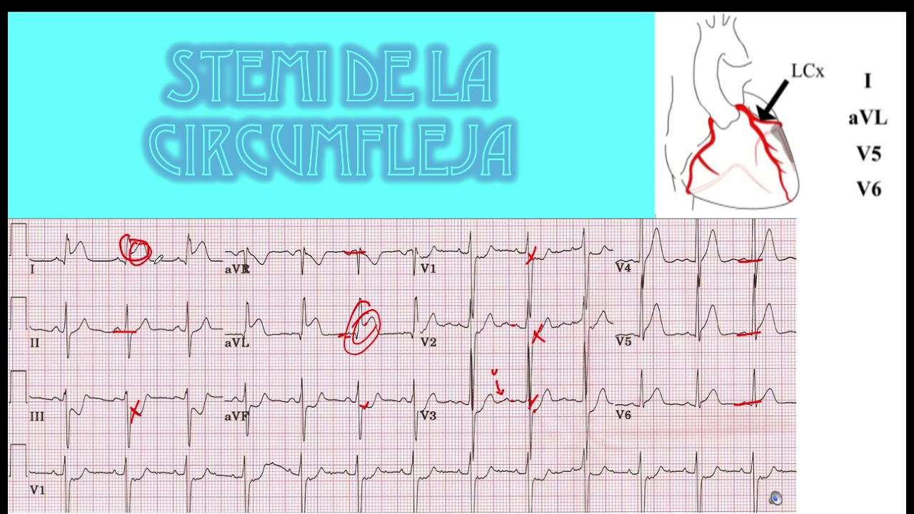 Locaclización Infarto  EKG