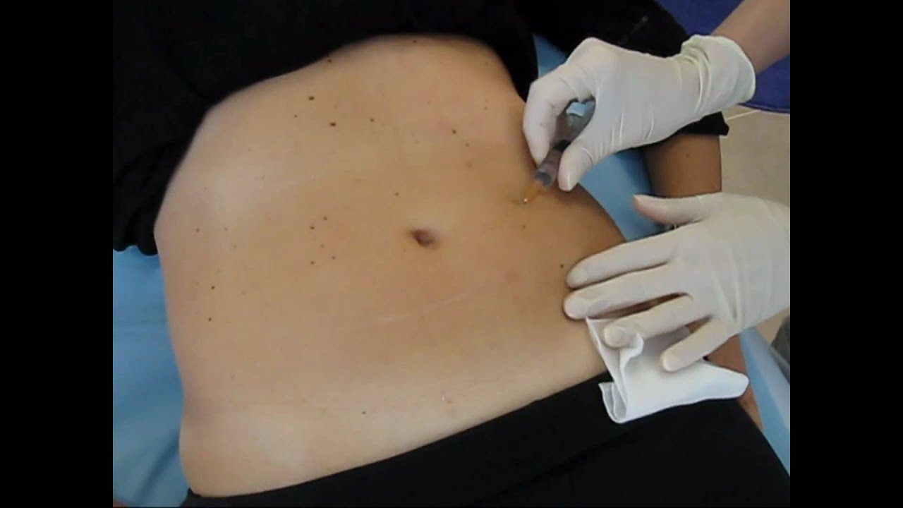 Intralipoterapia: la alternativa a la liposucción