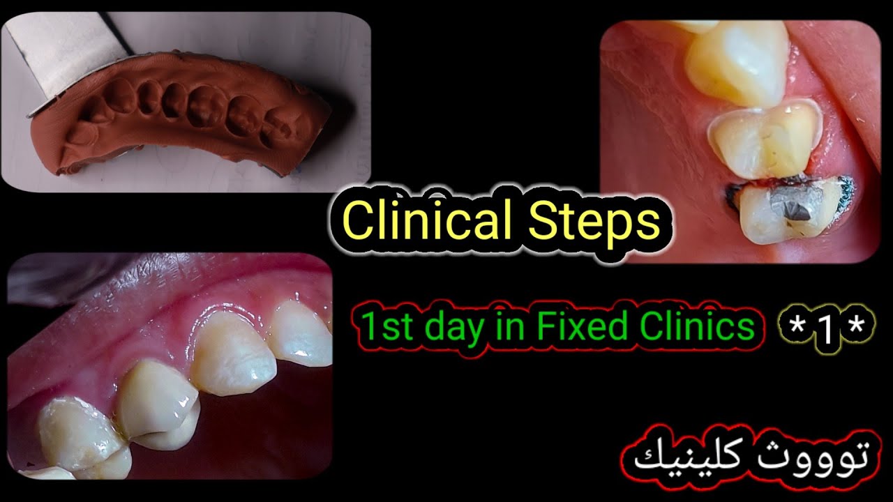 1st Day in Fixed Clinics,  Clinical Steps In Fixed Clinics  اول يوم في عيادة الكراون #الحلقة الاولي