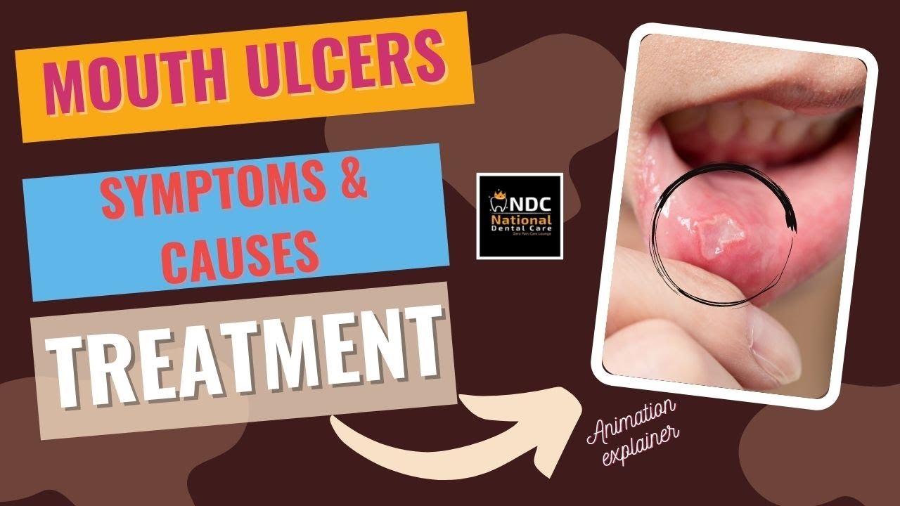 Mouth Ulcers Symptoms and Treatment || How To Get Rid Of Canker Sores || NDC