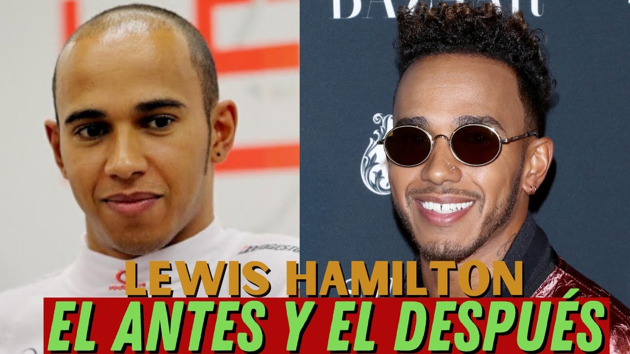 ¿CÓMO HA RECUPERADO SU PELO FRONTAL LEWIS HAMILTON? // FAMOSOS CON ALOPECIA