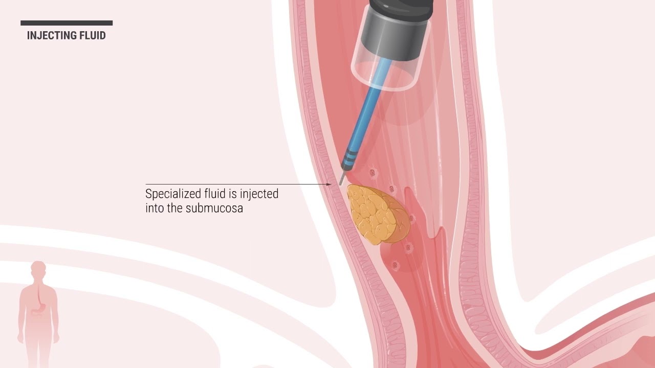 Endoscopic Submucosal Dissection