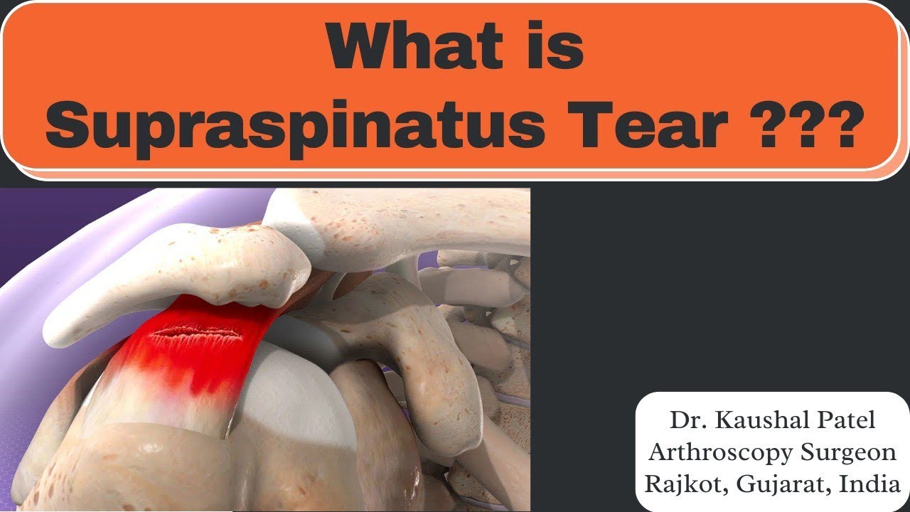 What is Supraspinatus tear ? #shoulderligamentsurgery #rotatorcufftear