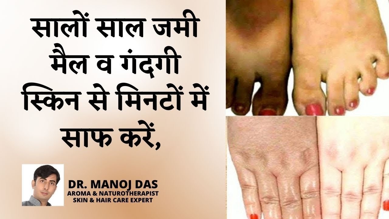 सालों साल जमी मैल व गंदगी स्किन से मिनटों में साफ करें| Remove, Dirt, Dead Skin Cells, DR. MANOJ DAS