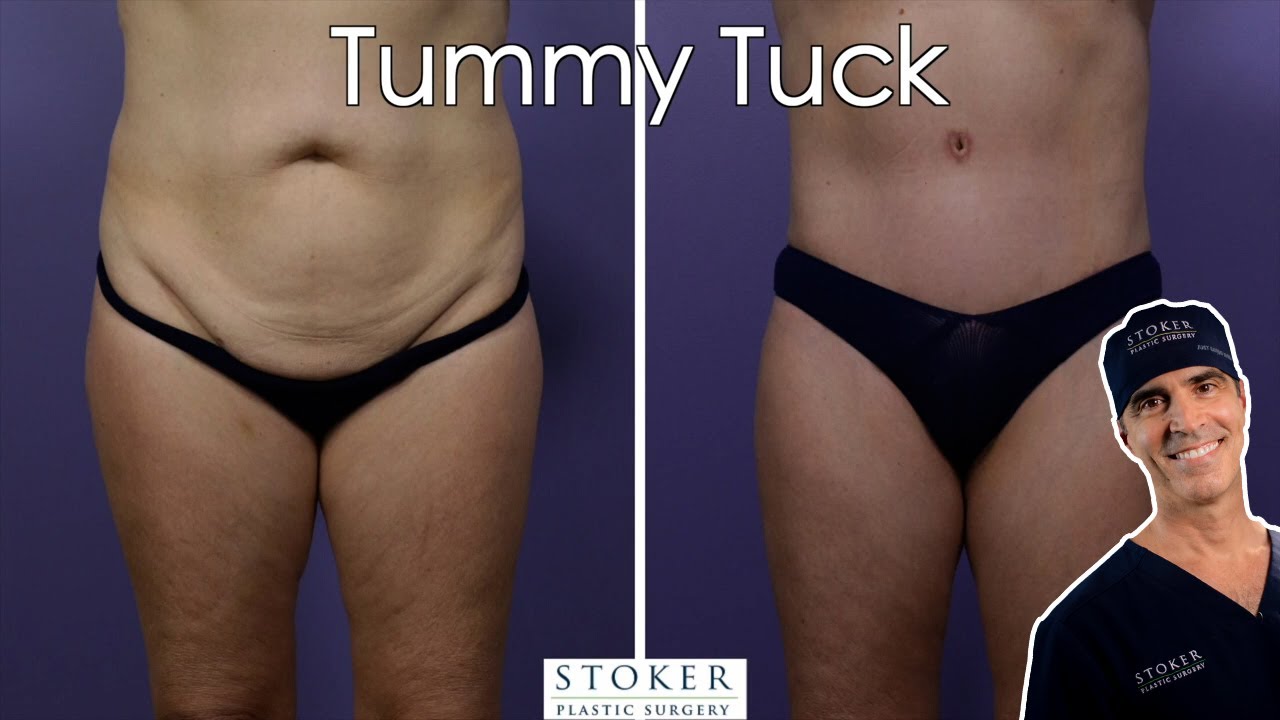 Tummy Tuck Los Angeles: Top Plastic Surgeon Dr. David Stoker Explains Secrets to Beautiful Results