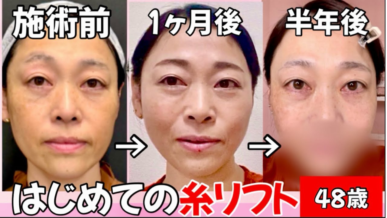 【40代糸リフト】治療直後、鏡を見て思った事は...。ダウンタイム〜半年後をお見せします。　　　　　やりたいけど痛い？気をつける点も合わせてお話し致しました。