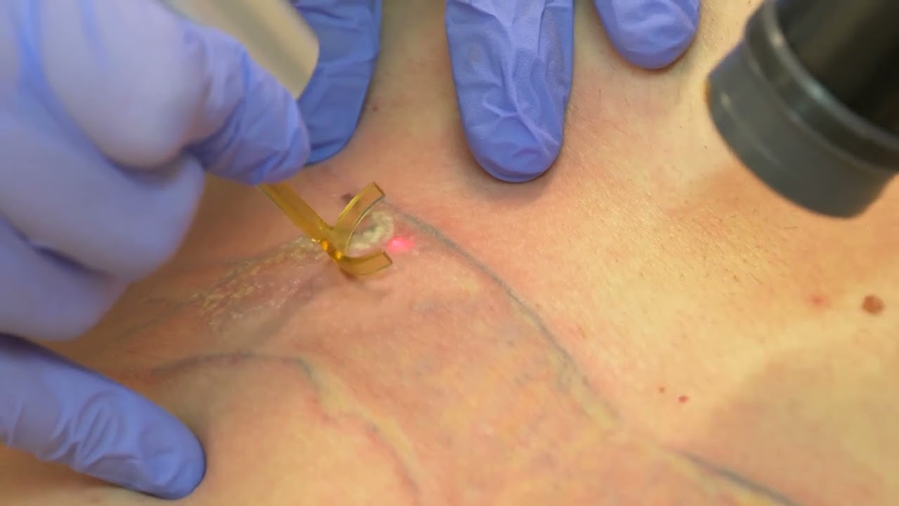 Eliminación de tatuaje negro profesional con el láser PicoWay mostrado por el Dr. Jaime Company