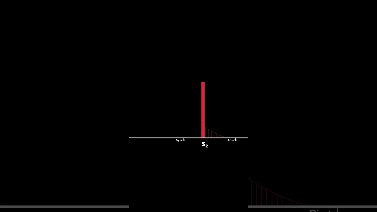 Aortic Regurgitation