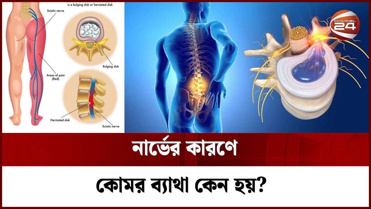 নার্ভের কারণে কোমর ব্যাথা কেন হয়? | Back Pain | Channel 24