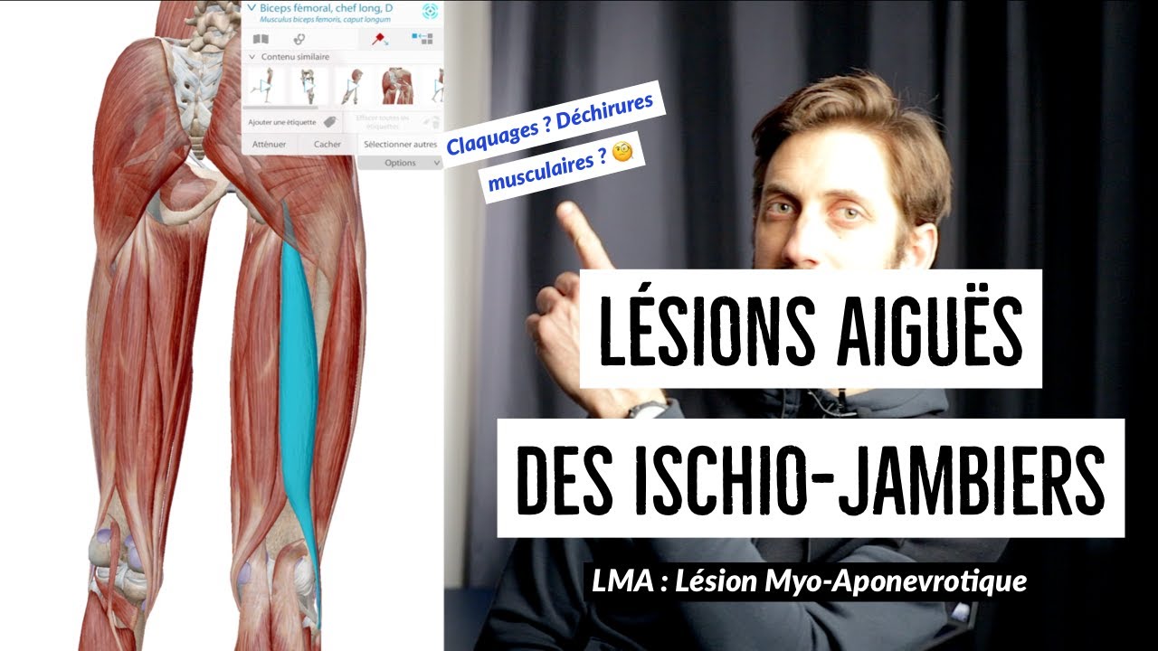 Lésions aigües des ischio-jambiers (LMA) dans le sport : explications par Kiné