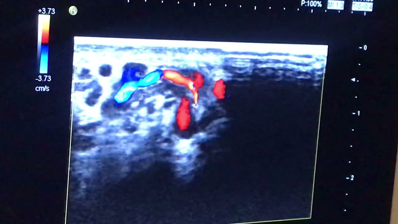 VARİKOSEL TEŞHİSİ: Renkli Doppler Ultrason ile Ayakta Yapılan Muayenenin Önemi