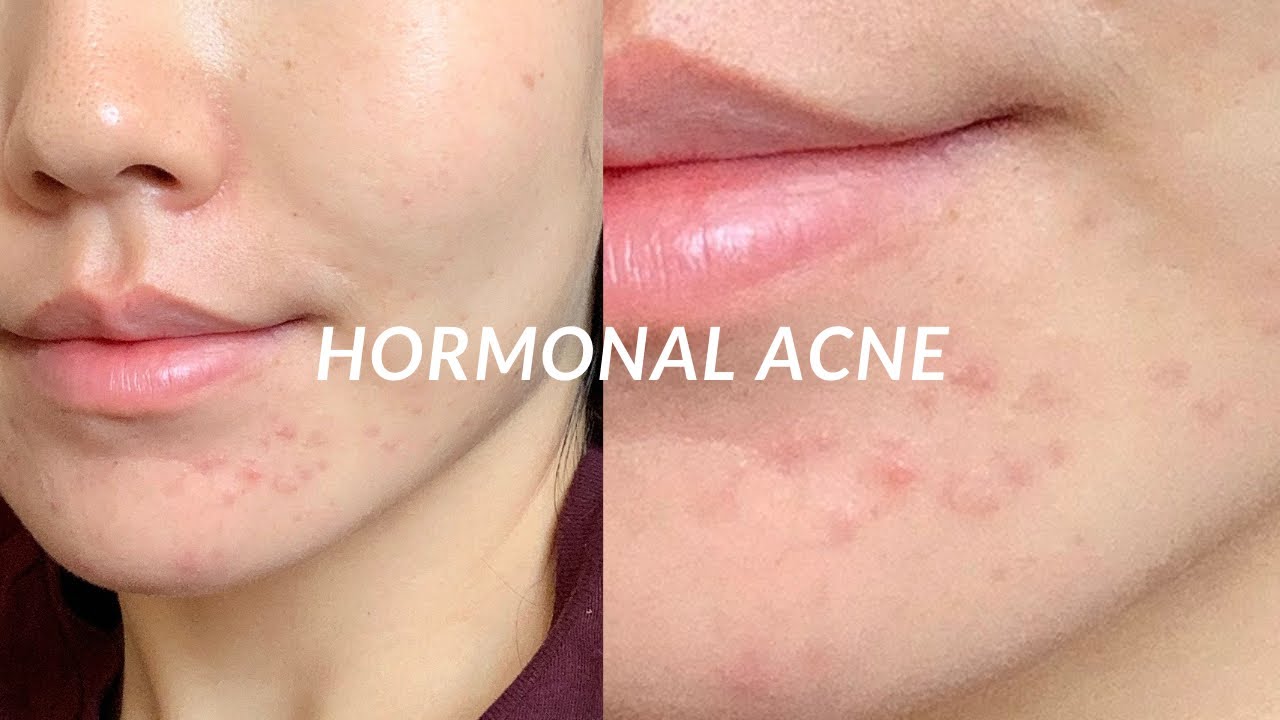 HORMONAL ACNE (миний зуны турш тэмцсэн гормоны батганы түүх болон хэрхэн эдгээсэн тухай 🤩)