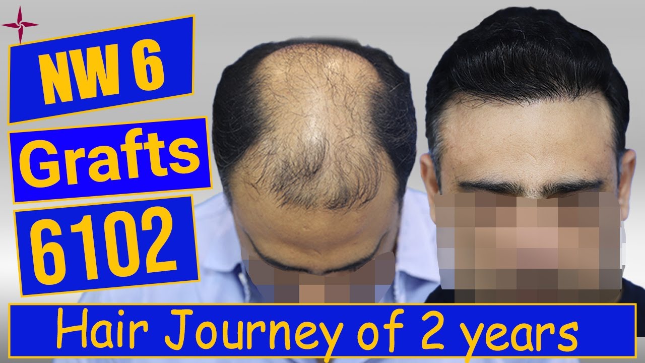 Hair Transplantation Result in 2 Year, 6102 Grafts, Grade 6  @Eugenix by Drs Sethi & Bansal