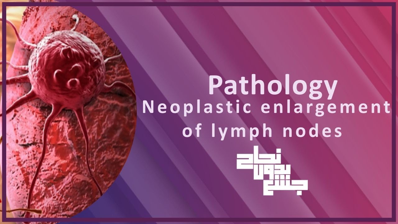 revision of L2, neoplastic enlargement of lymph nodes , patho