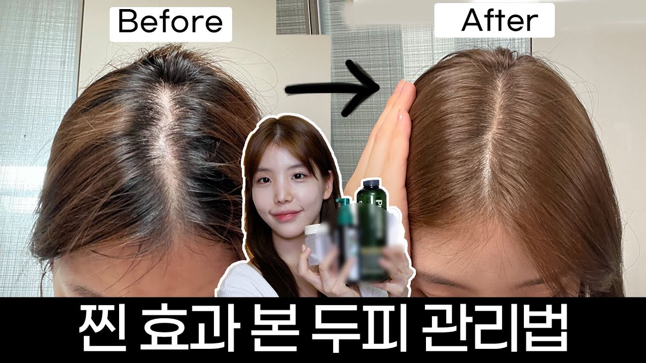 광고❌ 귀찮아도 할 수있는 가르마탈모 관리법💁🏻‍♀️두피영양제,샴푸추천
