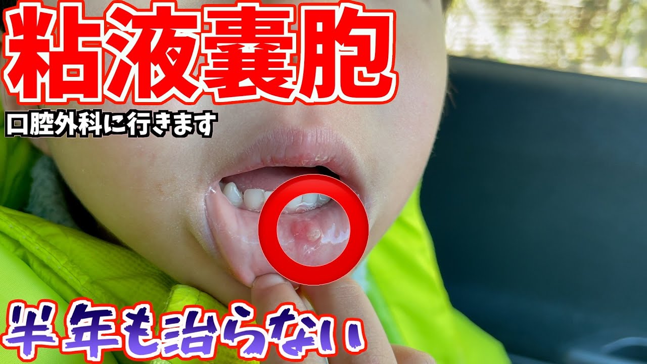 唇に半年もデキモノがあるので口腔外科に行ってきました