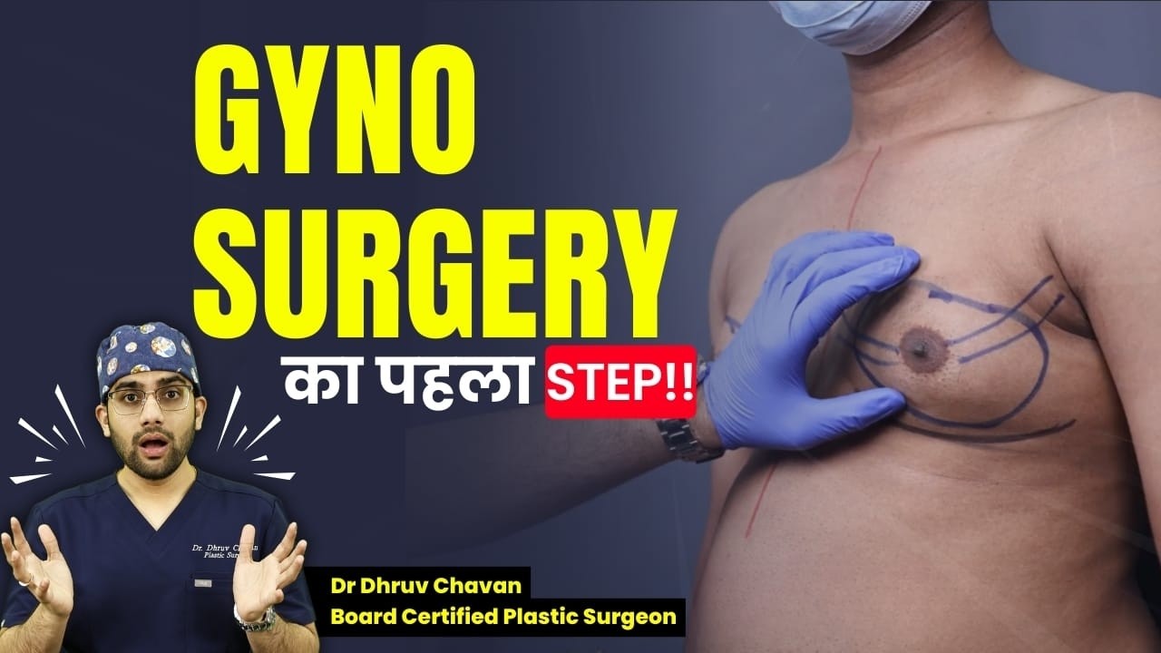 Gynecomastia Surgery Prep: देखिये Chest Marking Technique! | Dr DC, Plastic surgeon | Pune