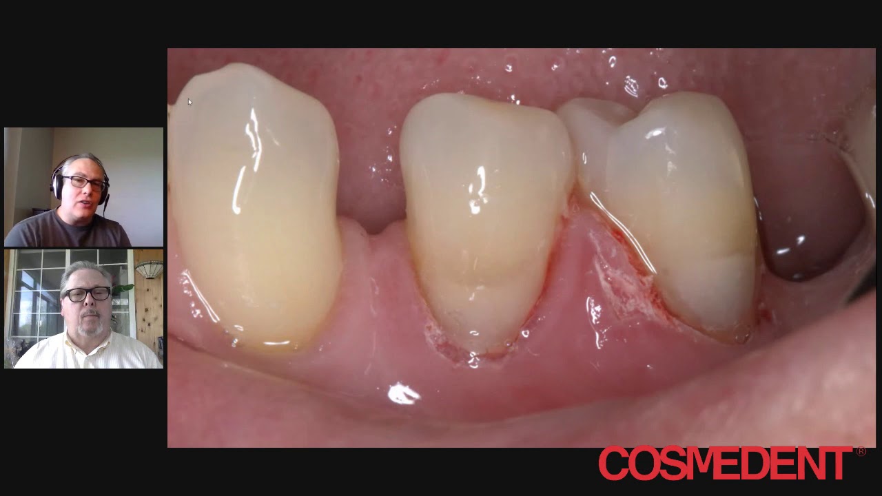 How to Make Cervical Restorations Invisible with Opaquers