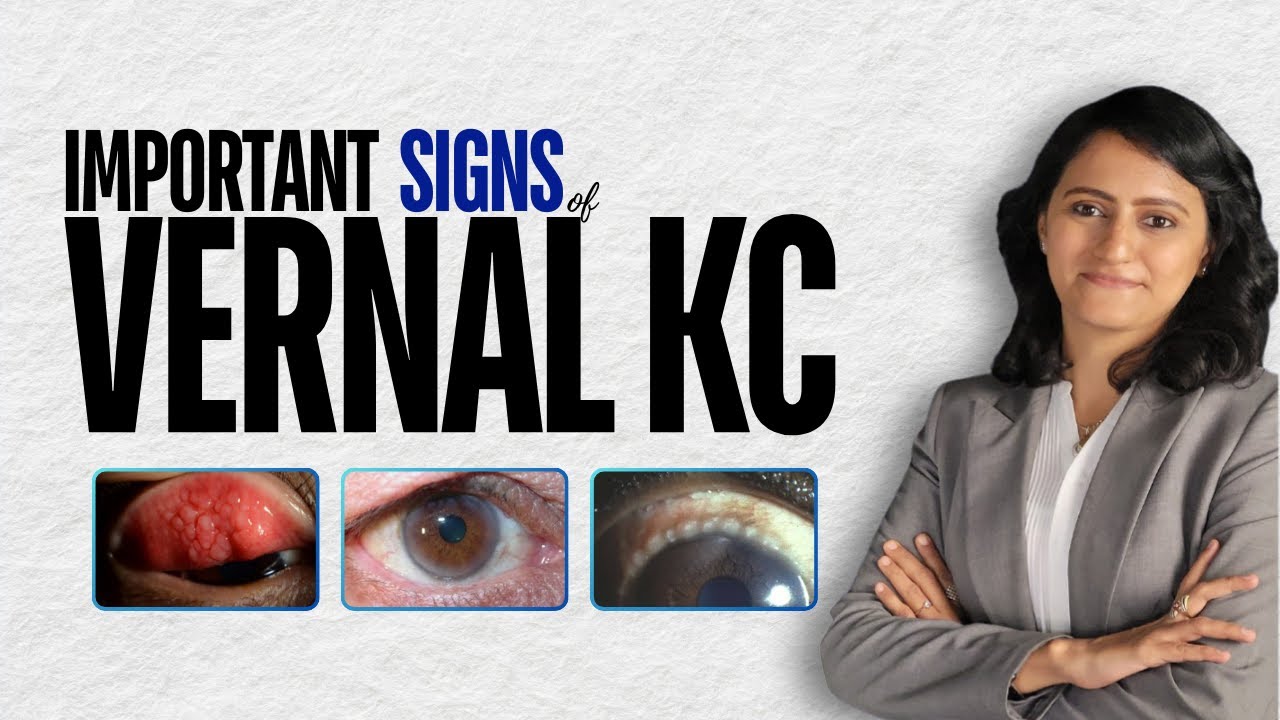 Important signs of Vernal KC - Nikmonic #neetpg