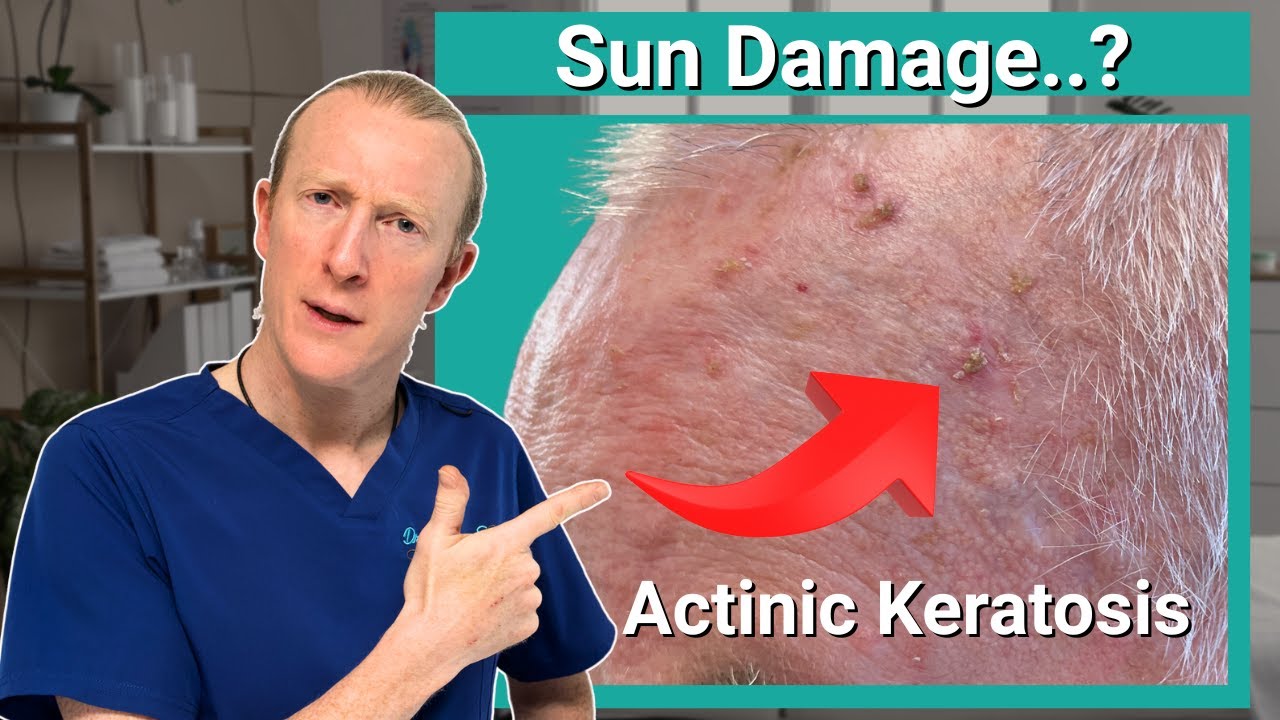 Solar Keratosis (Actinic Keratosis): Sun Damage Warning Signs