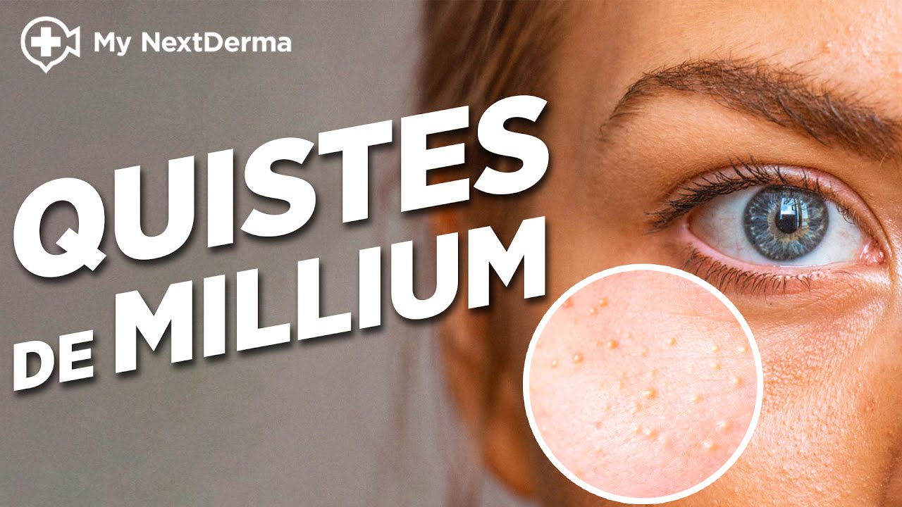 &iquest;Puntitos blancos al rededor de los ojos? &iexcl;ALTO! Son Quistes de Millium