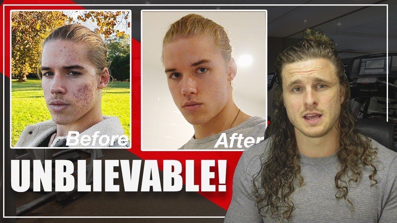 HOW I CLEARED MY ACNE IN 30 DAYS | REACTION