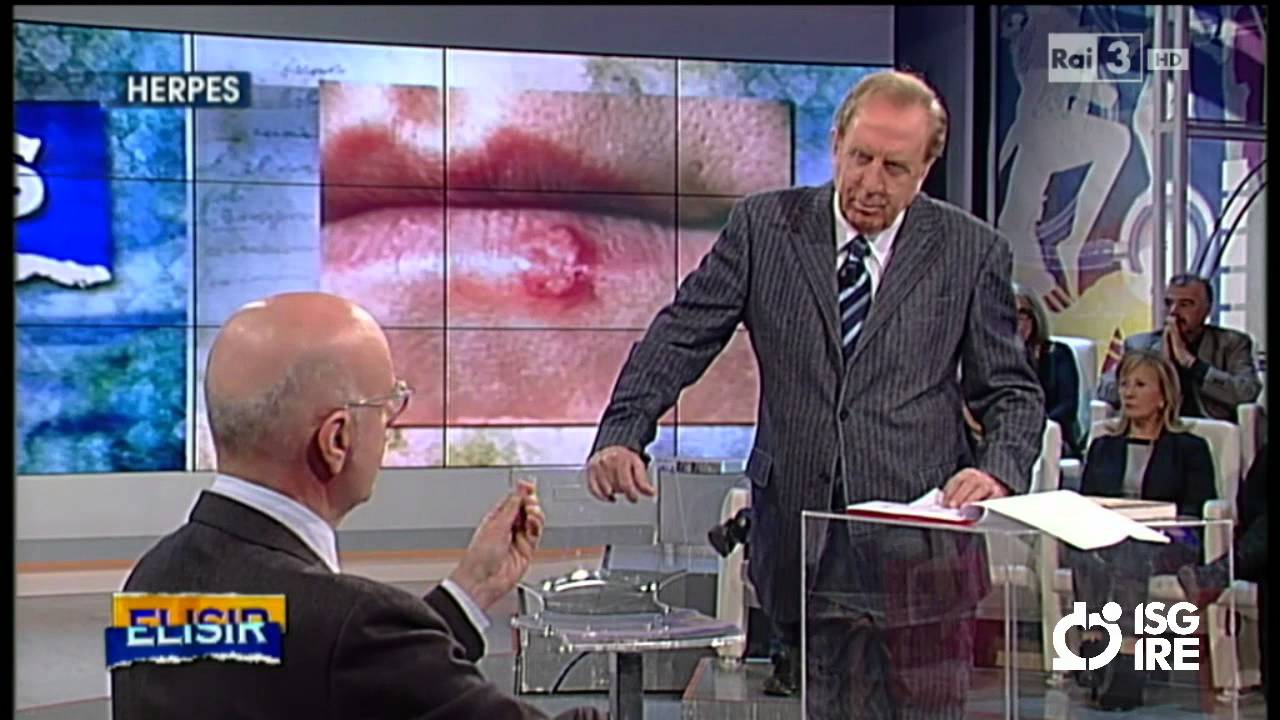 Tutto quello che c'è da sapere sull'Herpes