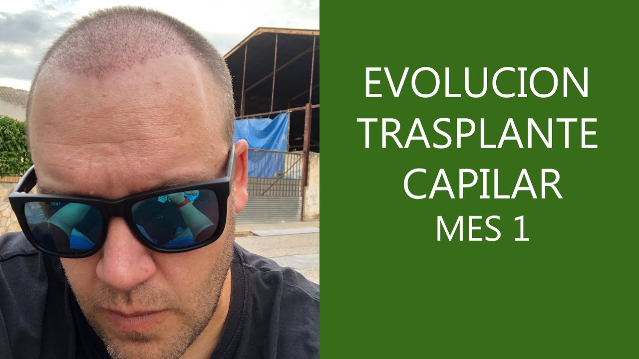 Evolución Trasplante capilar en Turquía - 1 mes