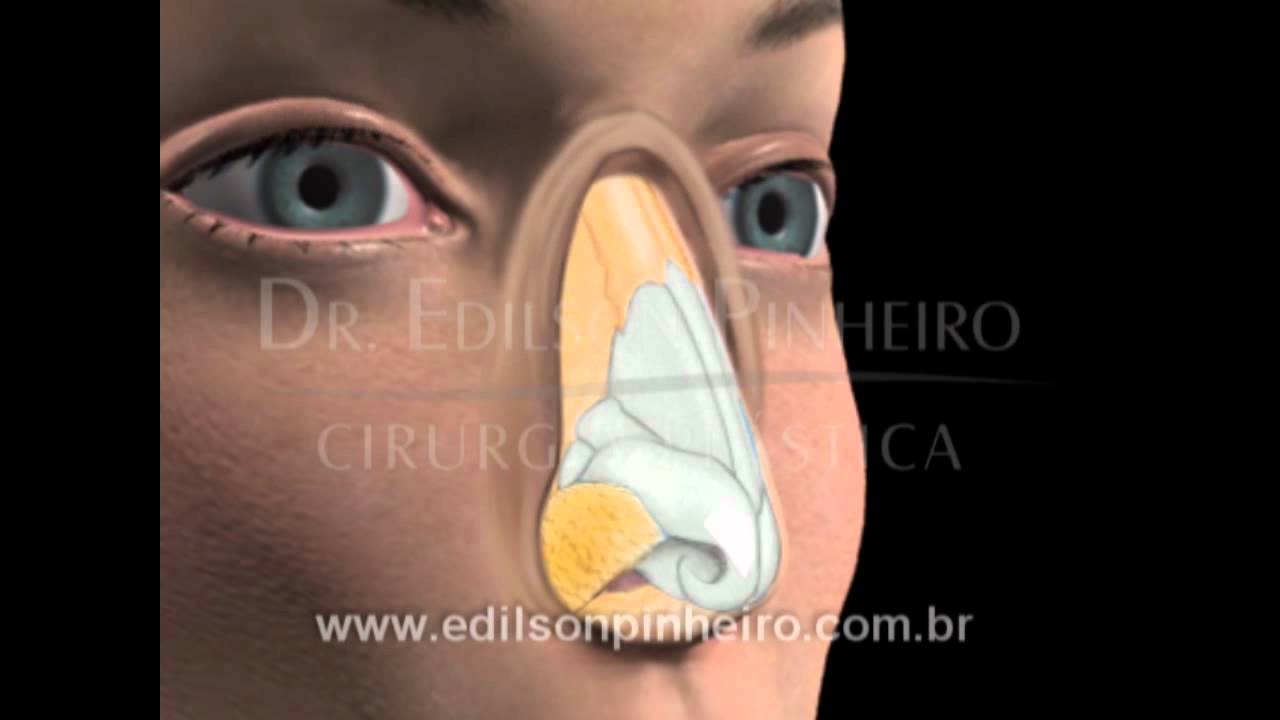 Rinoplastia Fechada - Cirurgia Plástica em 3D - Antes e Depois -  (Plástica do Nariz)