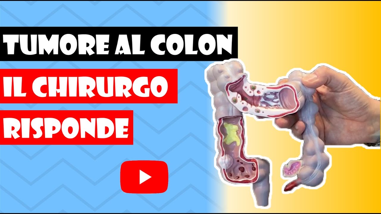 TUMORE AL COLON RETTALE: INTERVISTA al mio chirurgo Dr. Francesco Volonté