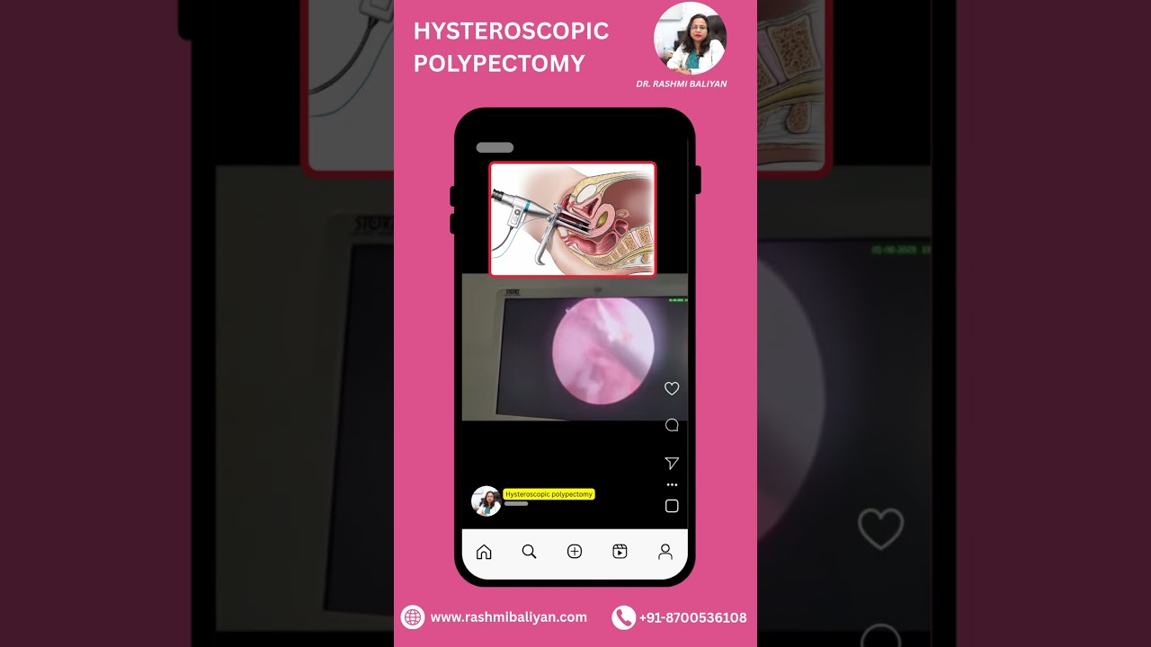 Hysteroscopic Polypectomy treatment in Delhi #hysteroscopic #polypectomy #rashmibaliyan