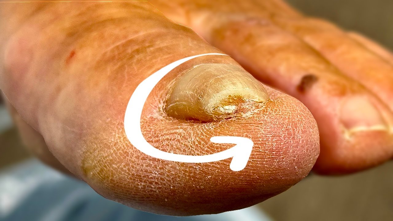 The Pressure Inside This Ingrown Toenail&hellip; WOW
