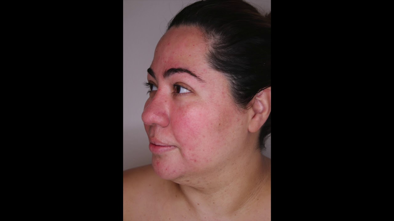 Shawna Porter Treating Compromised Skin in The Skin Games 2019 | Week 8