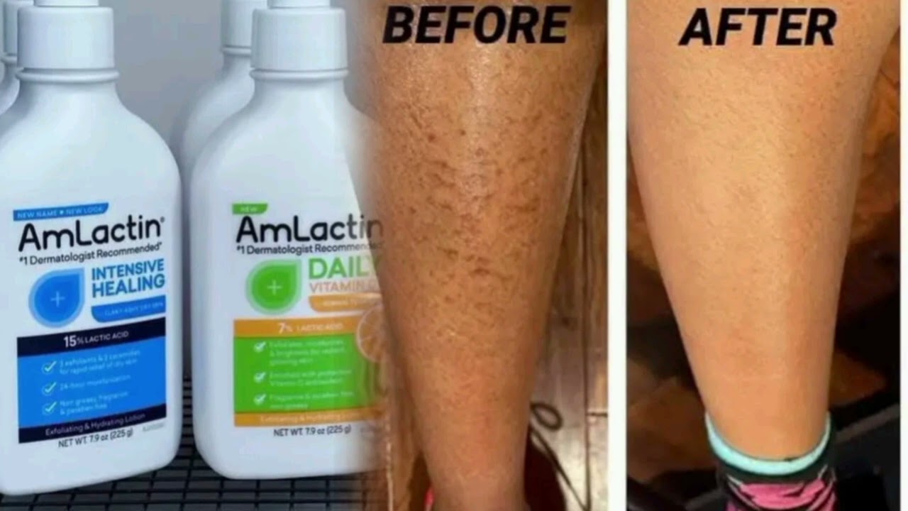 Have you tried Amlactin? Would you like to try it out? @AmLactin #bodylotion