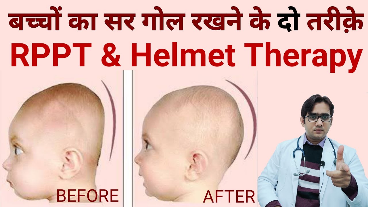 Flat Head Prevention and Treatment | बच्चे का सिर गोल कैसे करें | Plagiocephaly | Dr Md Noor Alam