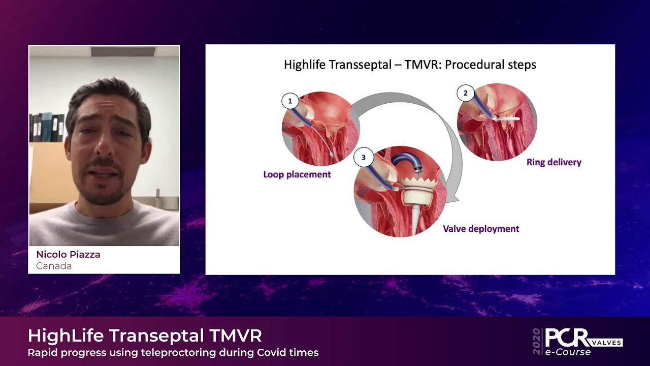 Transeptal TMVR – Rapid progress using teleproctoring during Covid times - PCR Valves e-Course 2020