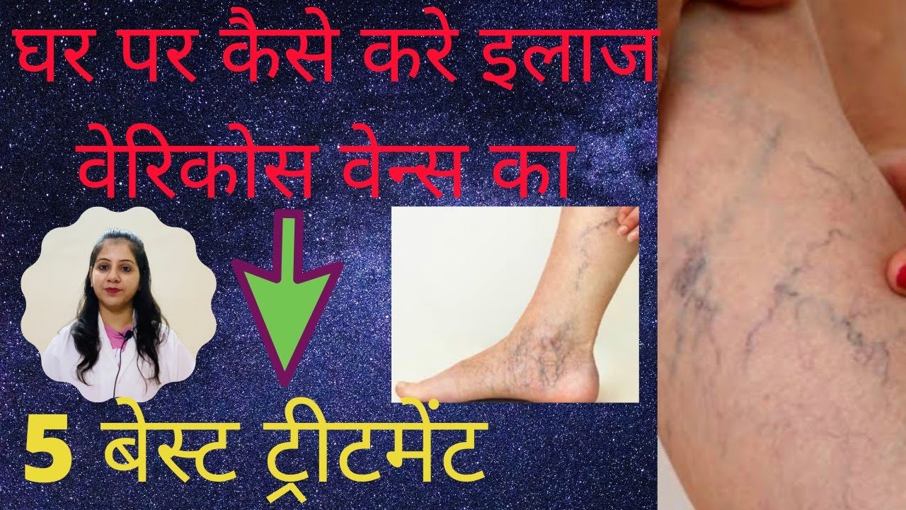 पाँवो की नस फूल जाने  (Varicose Veins) का इलाज  Varicose Veins treatment by Dr Nikita