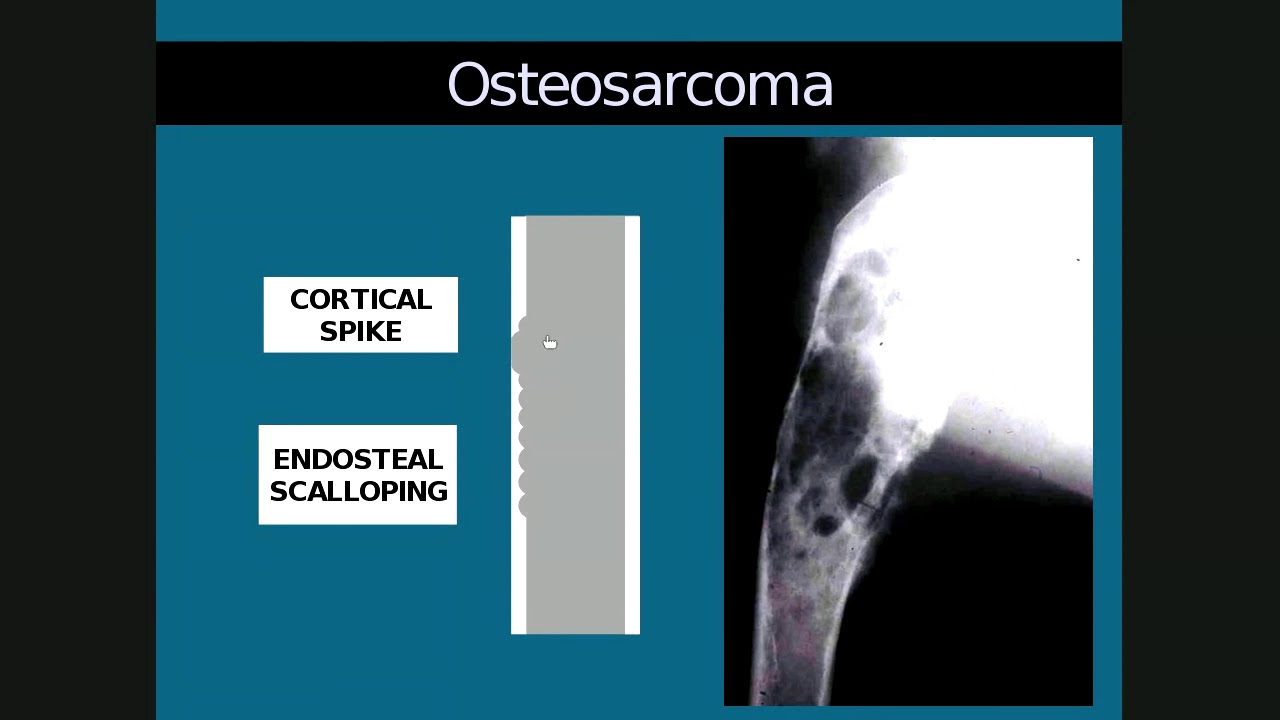 Lecture 4 Neoplasia