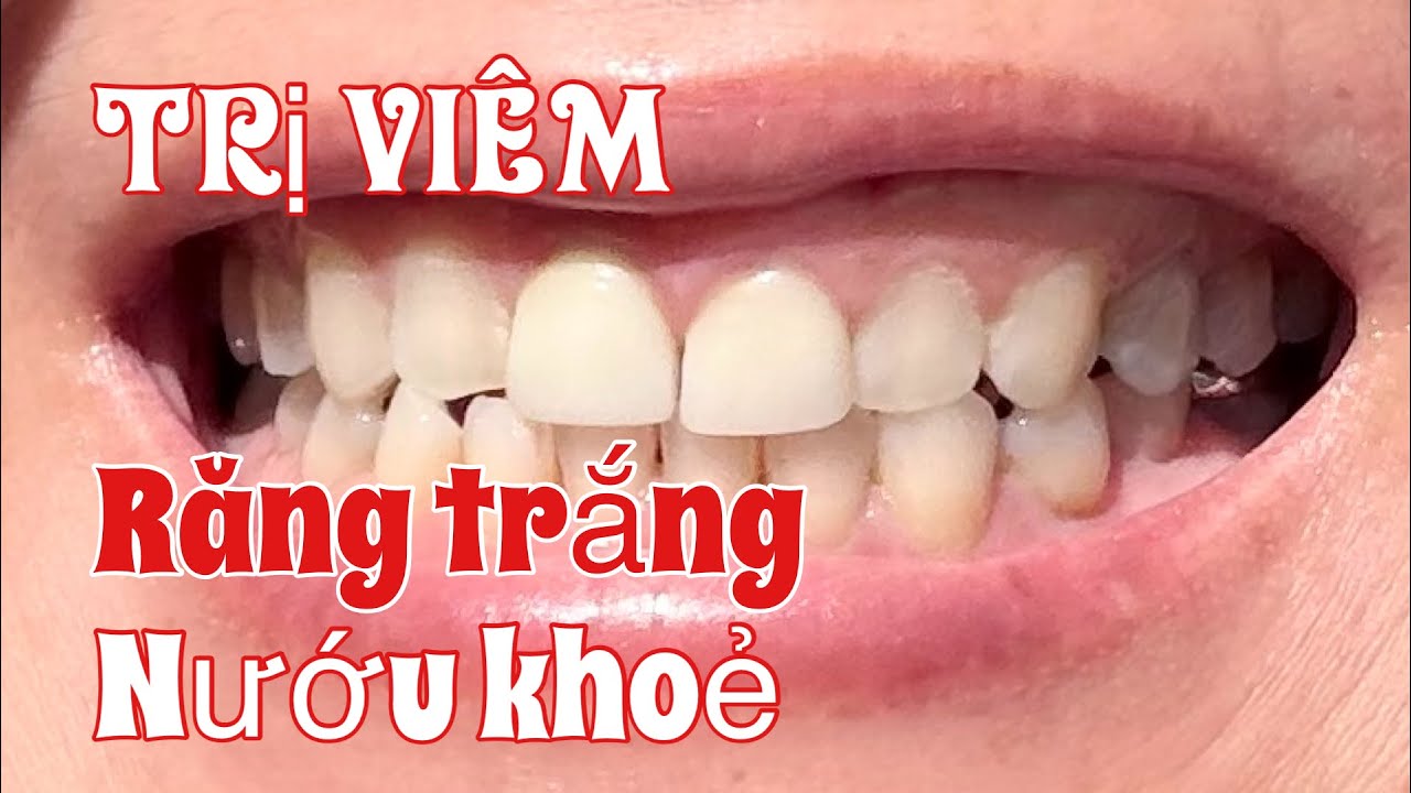 Cách trị viêm nướu răng, viêm họng, răng trắng, sâu răng, tóc khô, da khô tại nhà