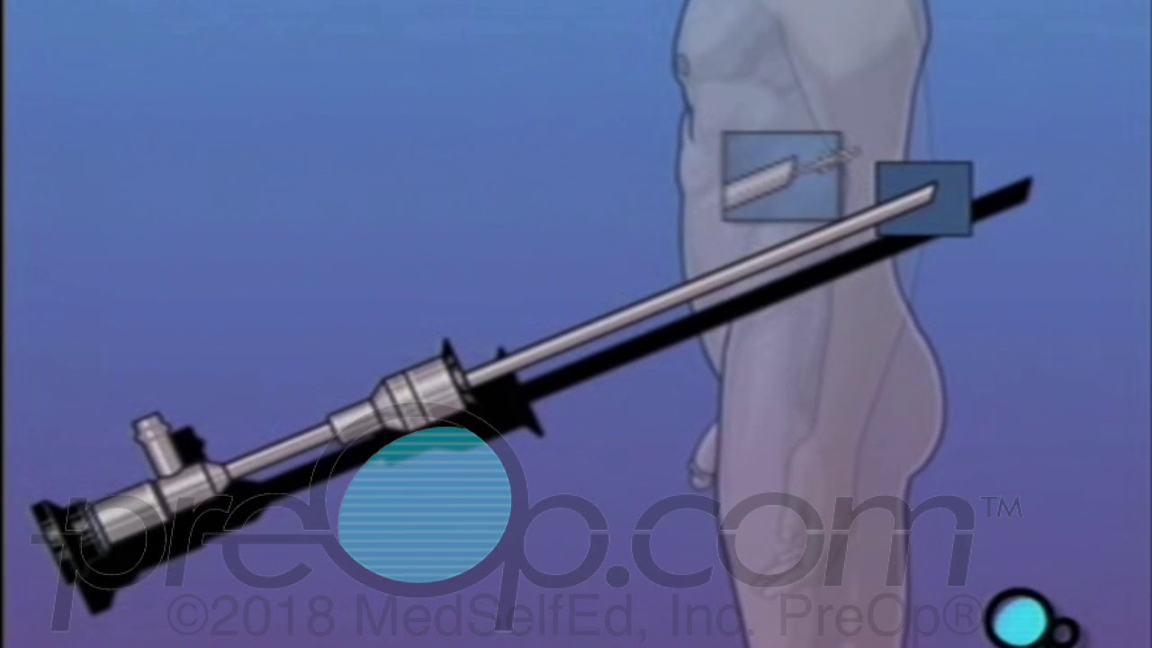 Cystoscopy Procedure Male  - PreOp® Patient Education and Engagement