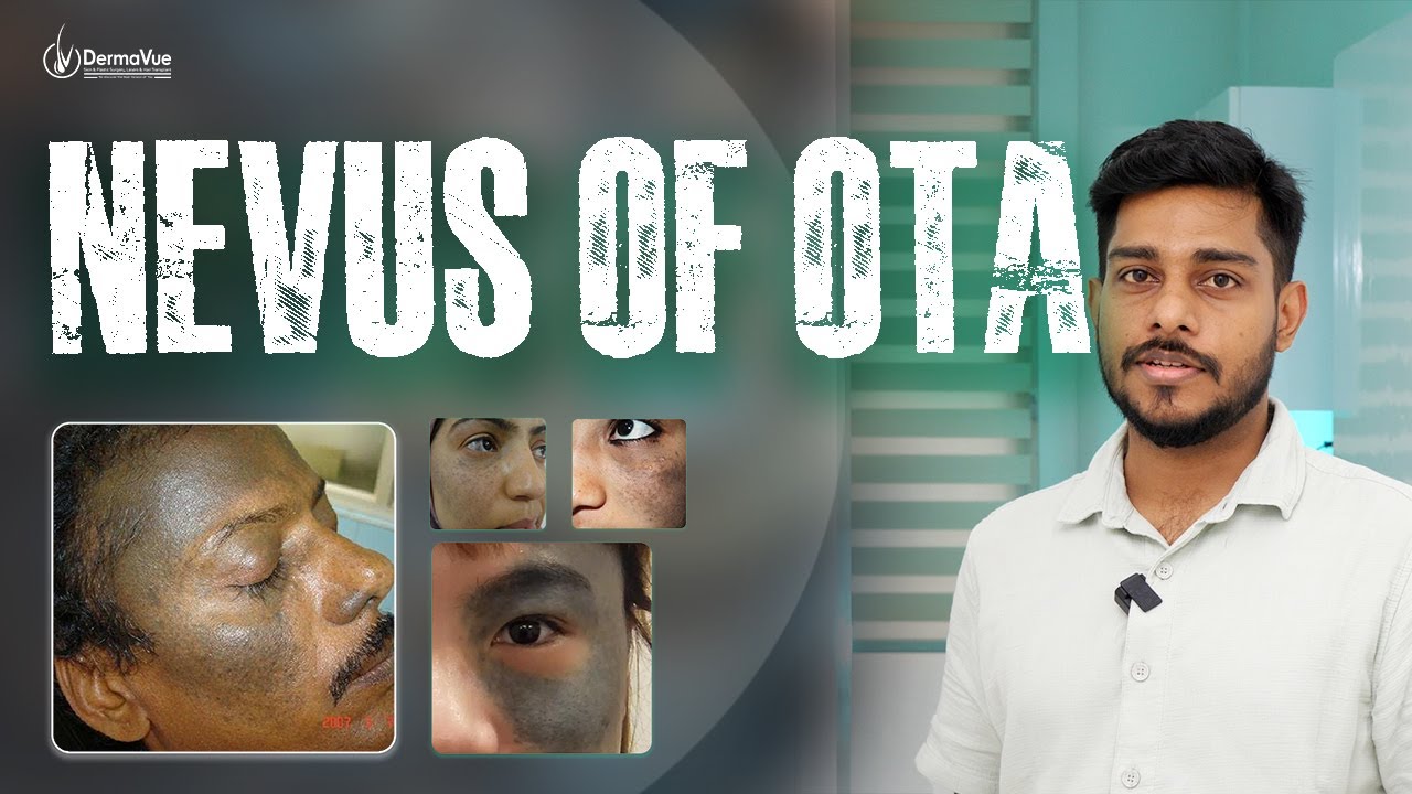 🌿Understanding Nevus of Ota: Causes, Treatments & Results Explained!✨@DermaVue