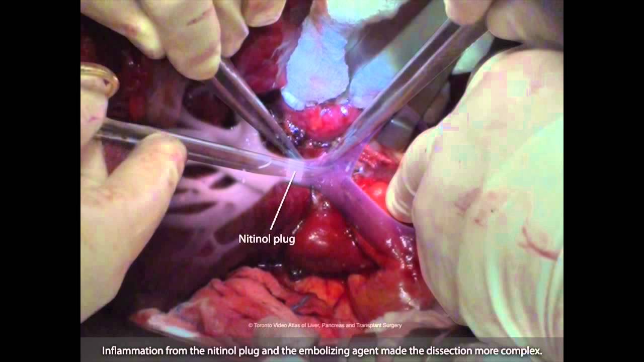 Standard right hepatectomy with PVE (Trailer) - TVASurg.ca