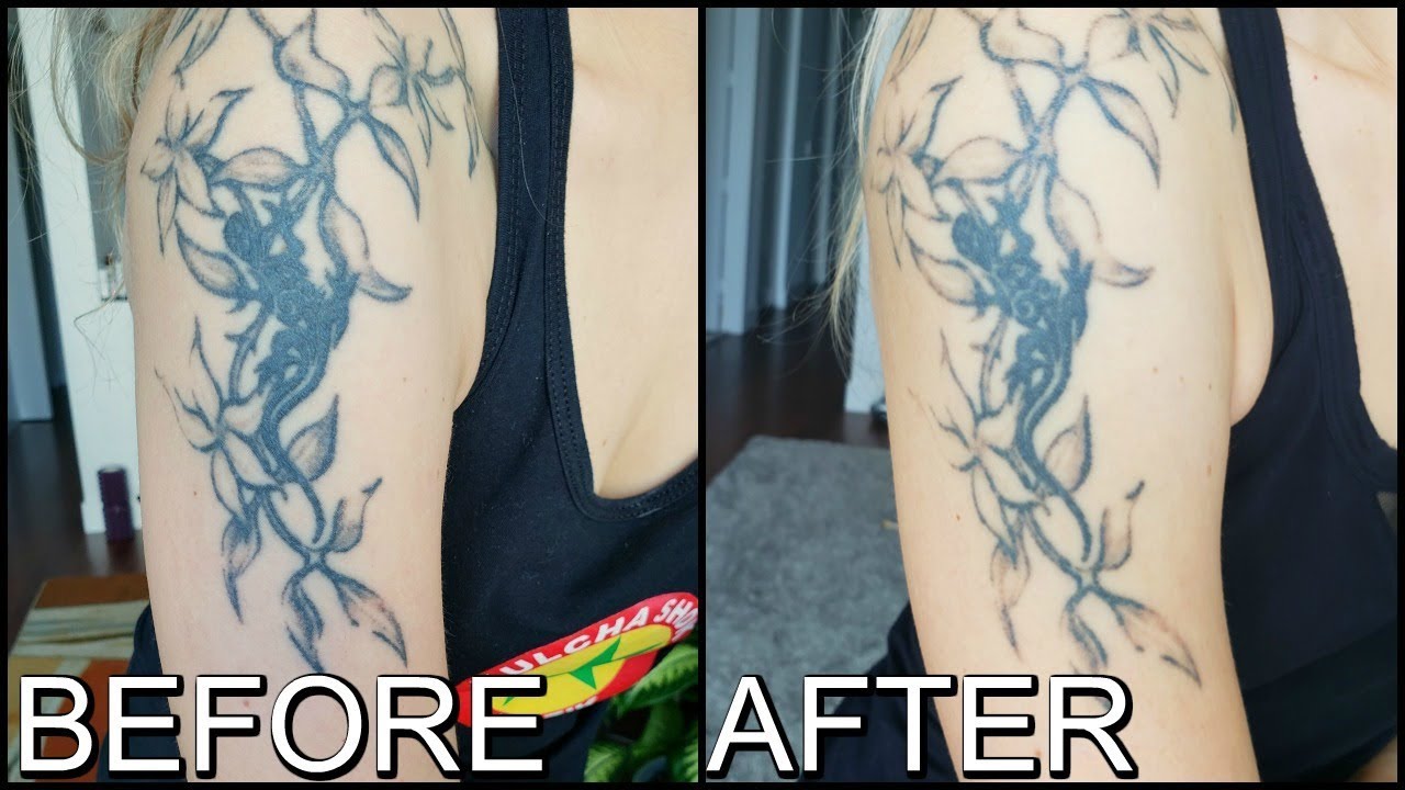 UPDATE ! Laser Tattoo Removal 3rd Session