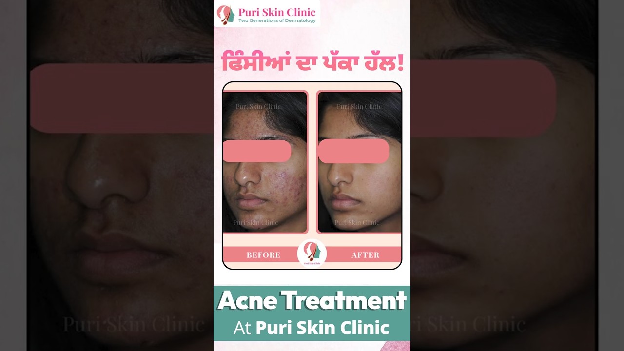 ਵਾਰ-ਵਾਰ ਹੋਣ ਵਾਲੇ ਪਿੰਪਲ ਦਾ ਇਲਾਜ | Acne Scar Treatment Cost in Ludhiana | Puri Clinic