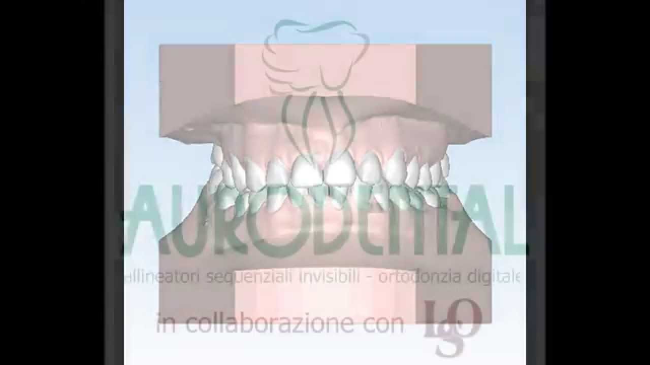Ortodonzia Invisibile Aurodental 21